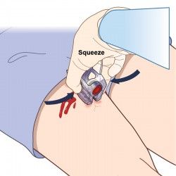 Dispositivo di chiusura ferite, sterile iTClamp™